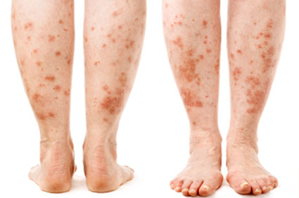 Eczema & Psoriasis – Lifelong Treatment & Coping with Depression